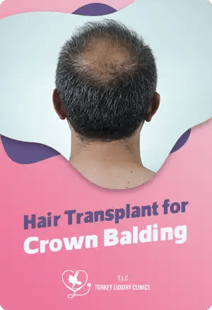 Hair Transplant for Crown Balding: Solutions and Results