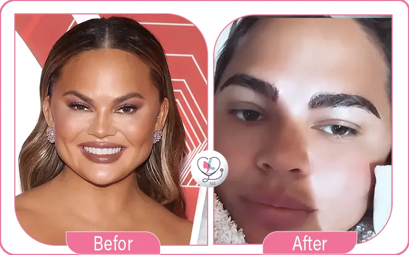 Before and After Eyebrow Transplant Celebrity