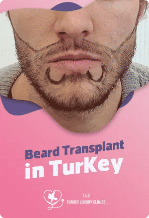 Barthaarverpflanzung in der Türkei: Kosten, Pakete & beste Kliniken
