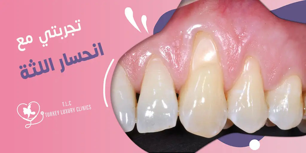 تجربتي مع انحسار اللثة: صور قبل وبعد العلاج في تركيا