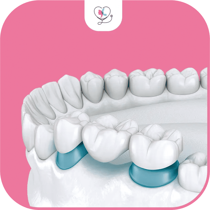 Impact du bridge dentaire sur la mastication