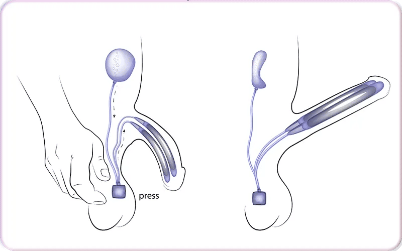 Types of Penile Implants