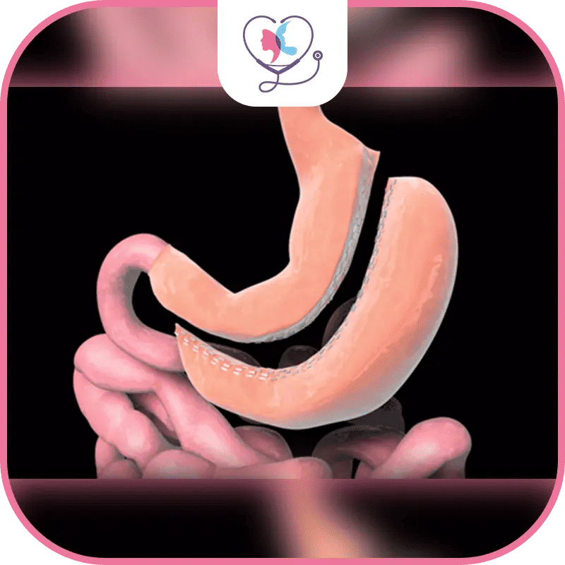 What is Gastric Sleeve?