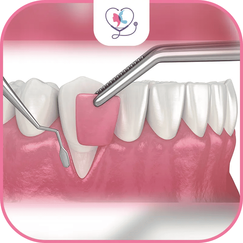 دواعي اللجوء إلى جراحة دواعم السن في تركيا