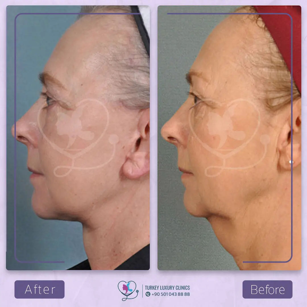 رابعاً: إغلاق الشقوق