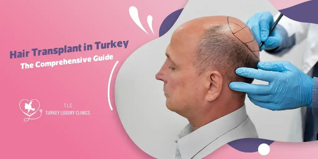 Trasplante de Cabello en Turquía: Guía Completa