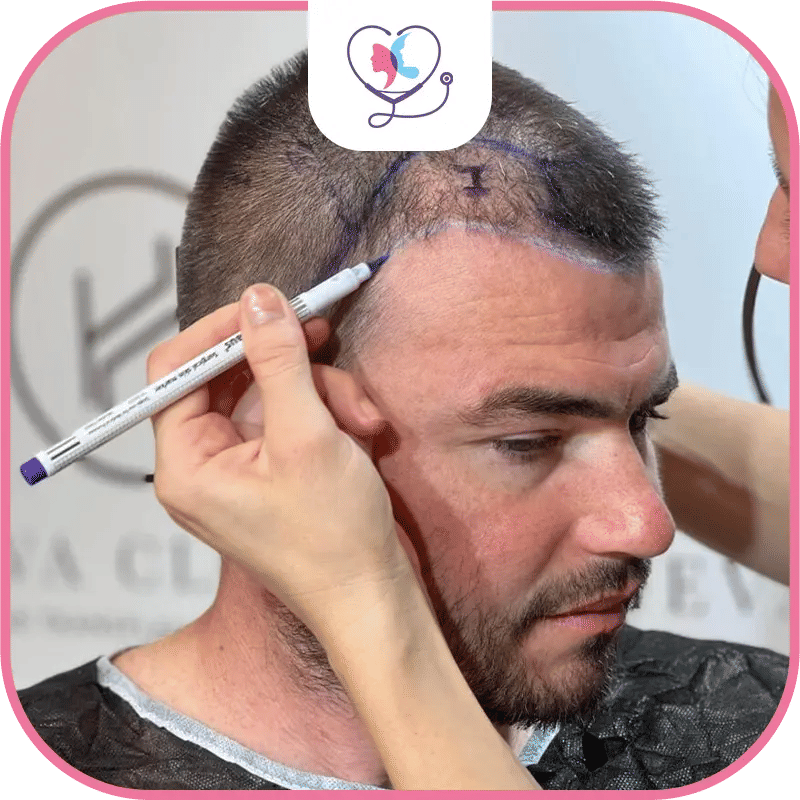 Step by Step Hair Transplant for Thinning Hair