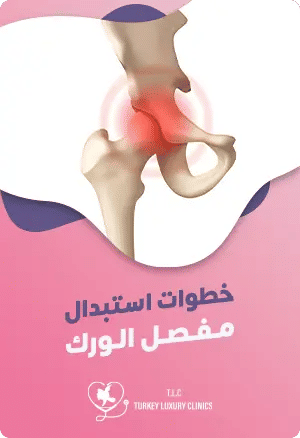 خطوات استبدال مفصل الورك: من التشخيص إلى العلاج والتعافيfeatured image