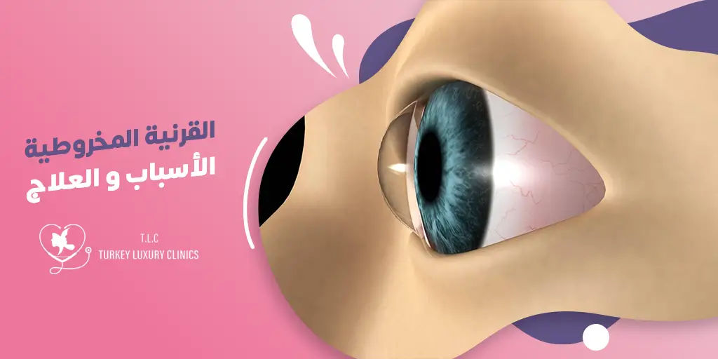 القرنية المخروطية: الأسباب، الأعراض والعلاج