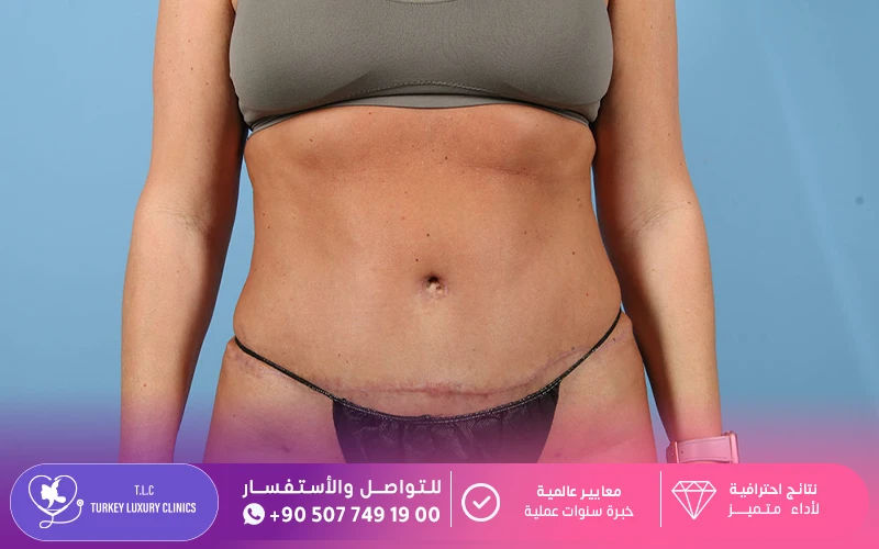التعافي بعد عملية شد البطن بعد الولادة القيصرية