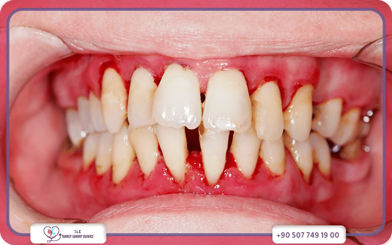 أسباب نزيف اللثة عند النوم