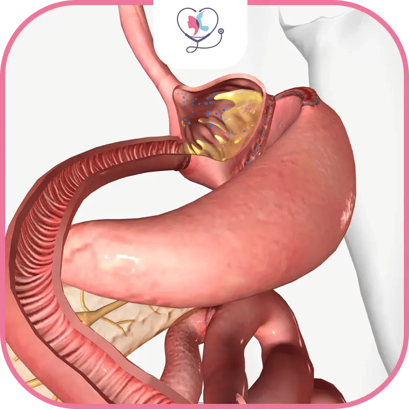 أسباب حالة سوء التغذية بعد تكميم المعدة