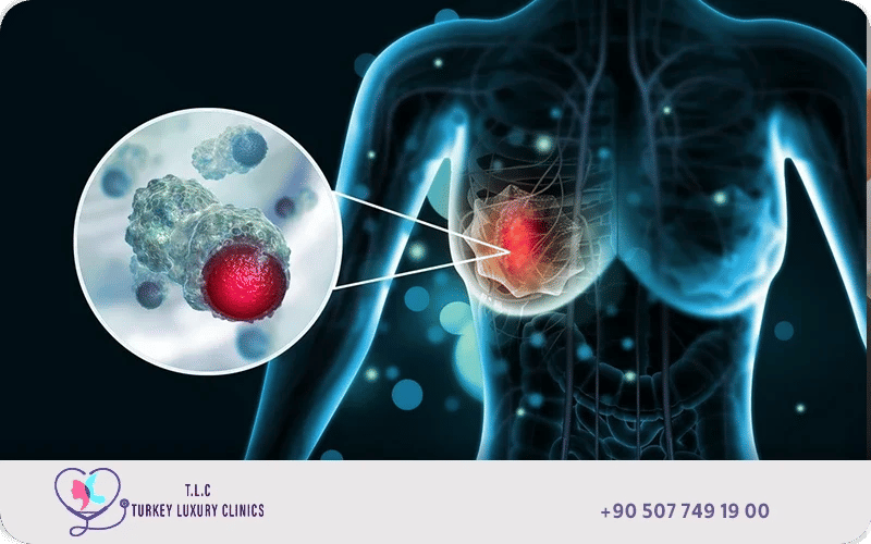 ما هو سرطان الثدي؟