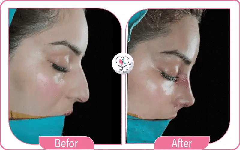 بعد عملية أرنبة الأنف الشكل والتشريح