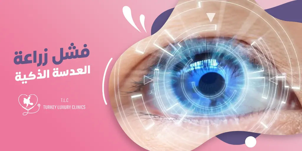 فشل زراعة العدسة الذكية