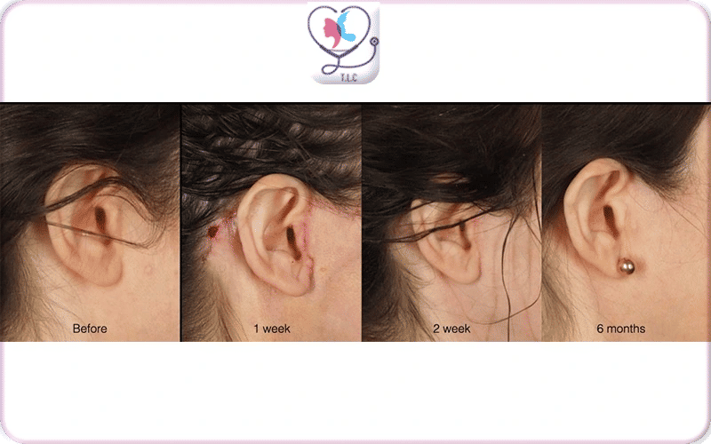 cicatrice mini lifting visage