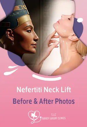 Nefertiti Neck Lift Before & After Photos: What to Expect
