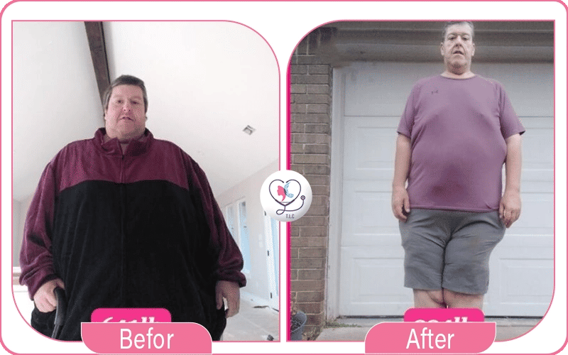 النتائج المتوقعة بعد عملية تكميم المعدة