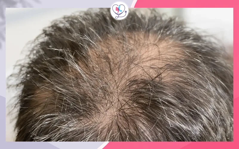 العوامل التي تؤثر على نجاح زراعة الشعر
