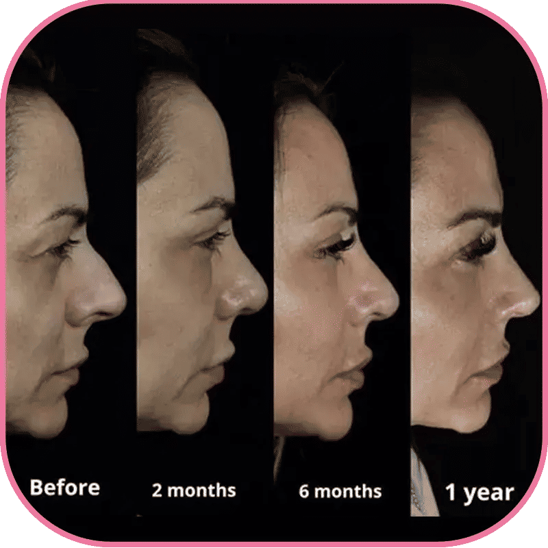 Gérer les effets secondaires courants de la rhinoplastie