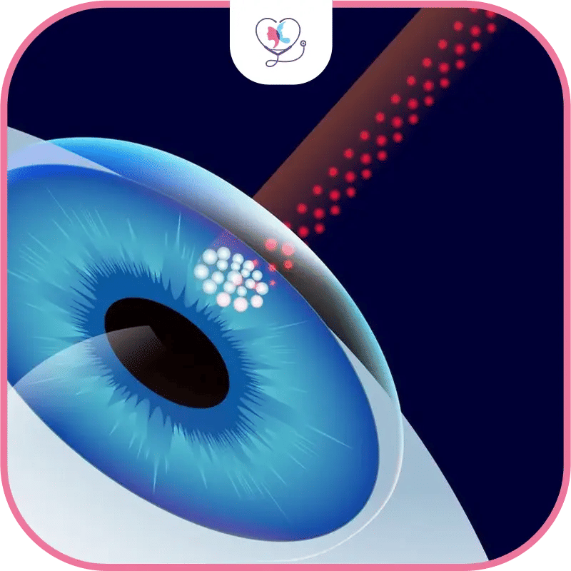 إجراء عملية الفيمتو ليزك للعيون باستخدام ليزر الفيمتو ثانية لتصحيح النظر