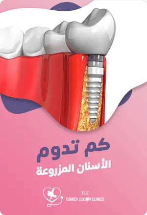 كم تدوم الأسنان المزروعة؟featured image