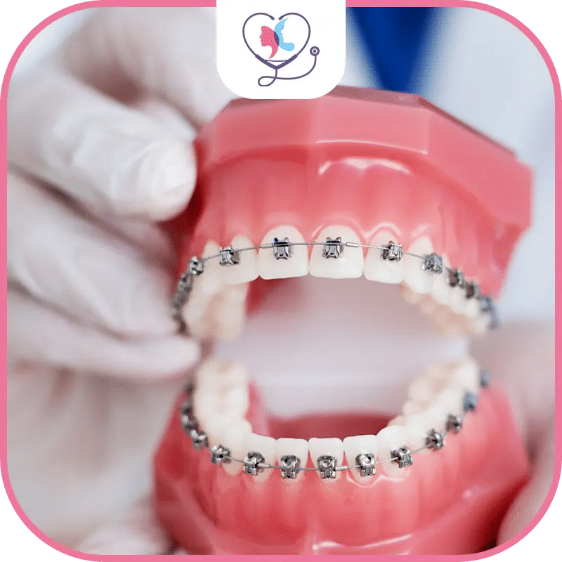 ما هي أسعار تقويم الأسنان في تركيا؟