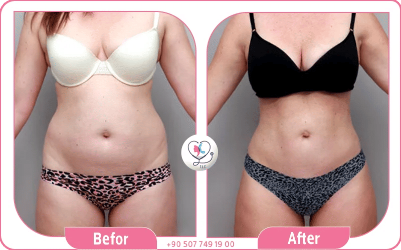 Mommy makeover Tummy Tuck eliminates post-pregnancy belly pooch for firmer, slimmer look.