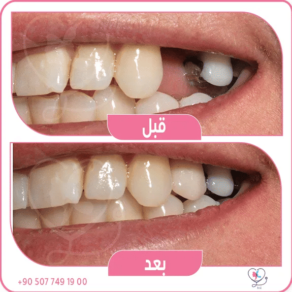 التاج النهائي