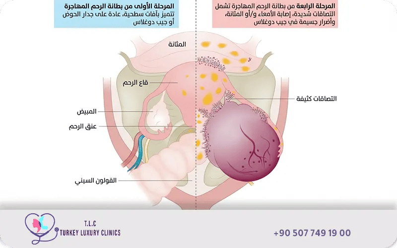 بطانة الرحم المهاجرة بالصور لدى تركيا لاكشري كلينك