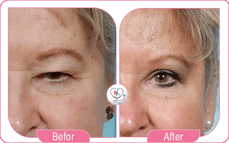 Avis sur la blépharoplastie laser