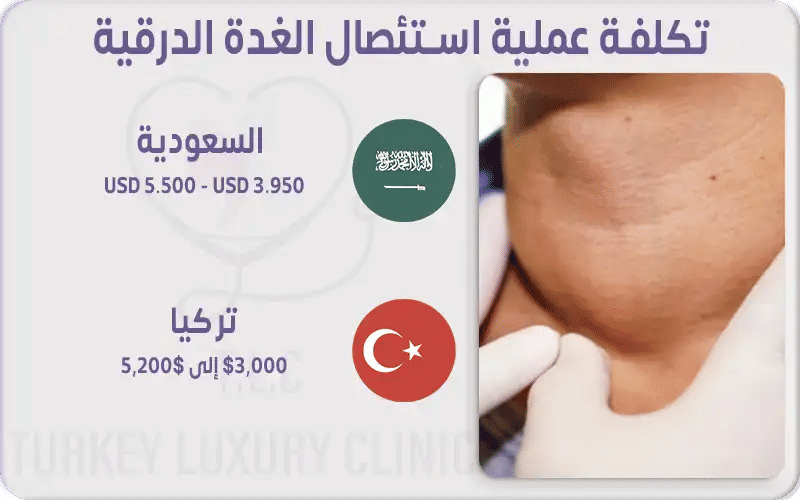 تكلفة عملية استئصال الغدة الدرقية
