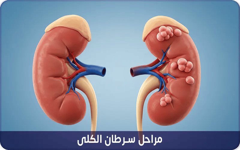 مراحل سرطان الكلى