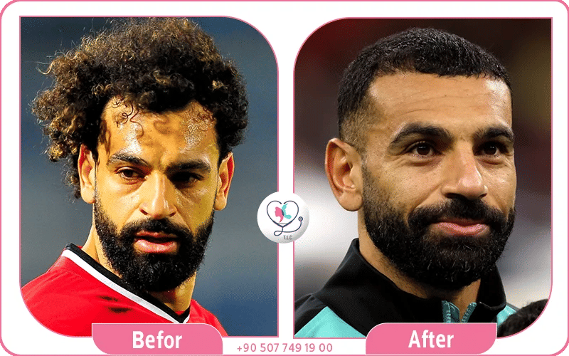 محمد صلاح قبل وبعد زراعه الشعر محمد صلاح قبل وبعد زراعه الشعر