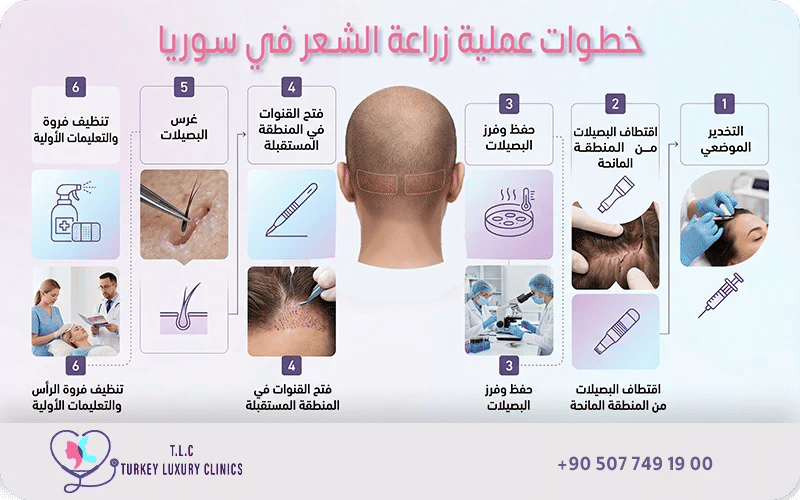 خطوات عملية زراعة الشعر في سوريا