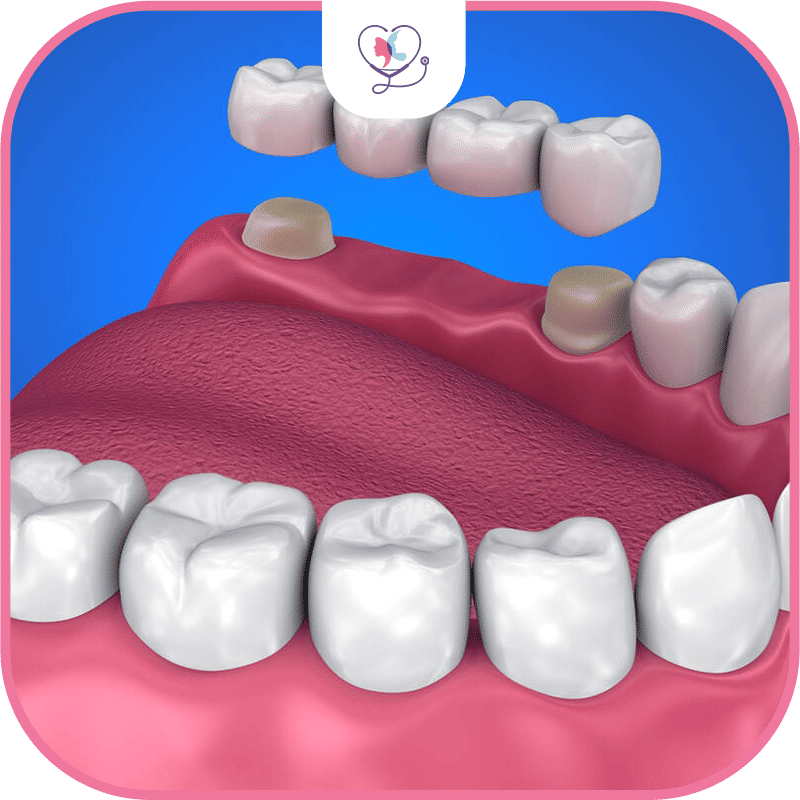 Dental Implants vs. Bridges: The Basics