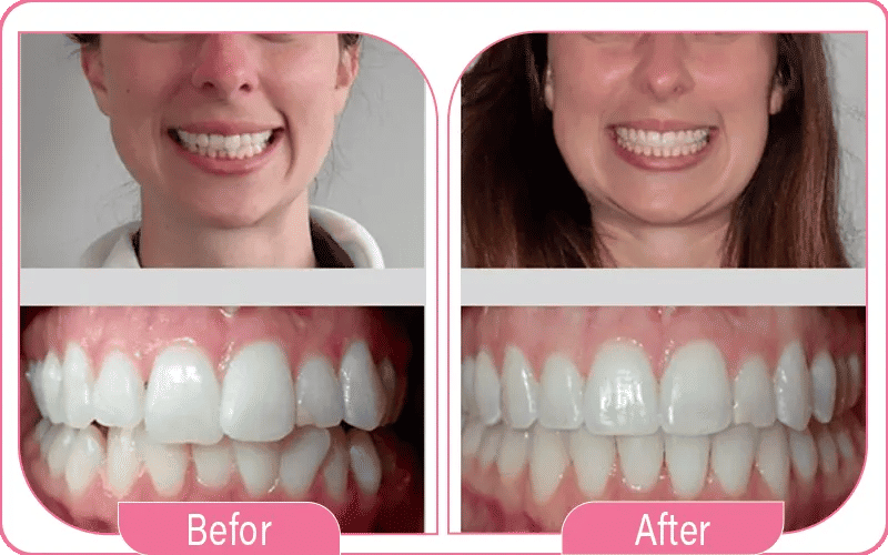 Can Invisalign Fix Overbite?