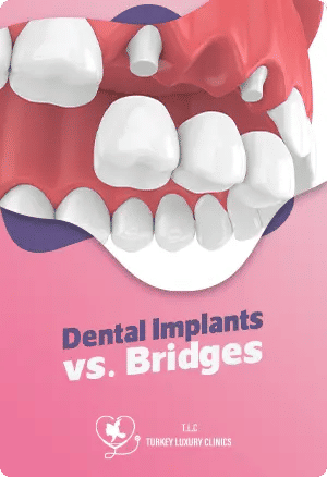 Dental Implants vs. Bridges: Finding the Best Solution for Your Unique Needsfeatured image