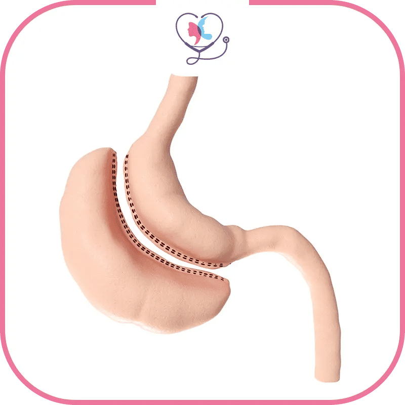 تكلفة جراحة تكميم المعدة في مختلف الدول: دراسة مقارنة
