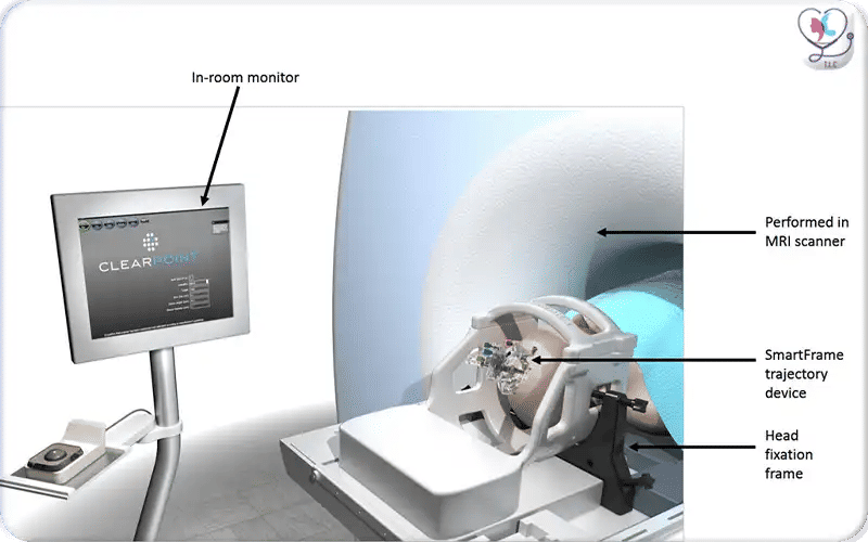 3. Lead Implantation (Awake vs Asleep) 3