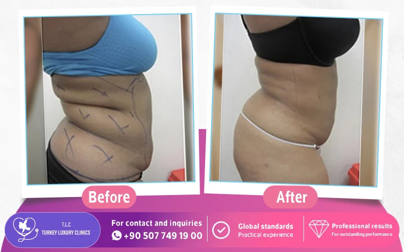 Laser Liposuction Before and After Photos