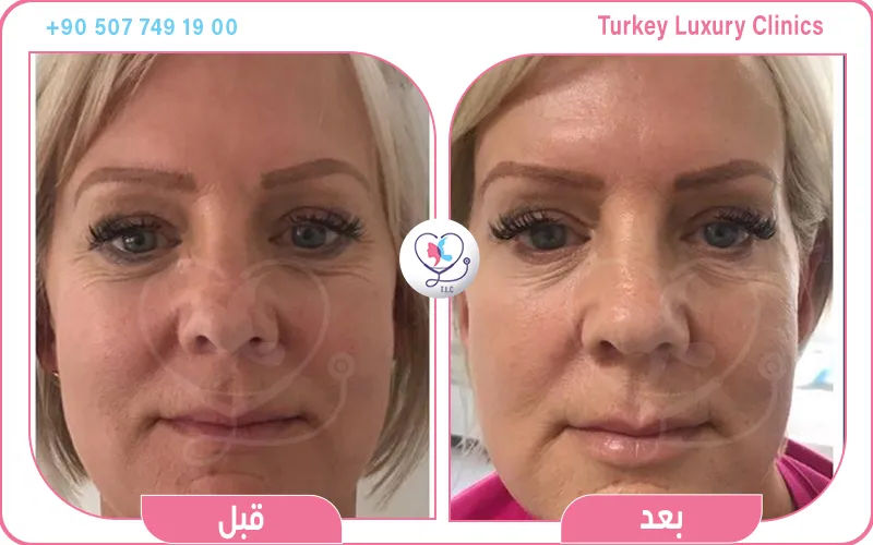 نتائج تجربتي مع ابرة البروفايلو