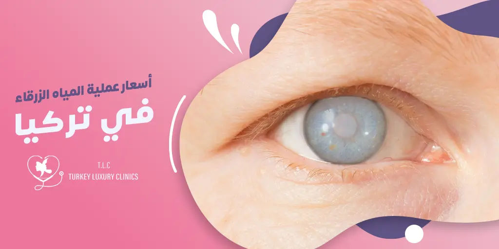 تكلفة جراحة الجلوكوما في تركيا
