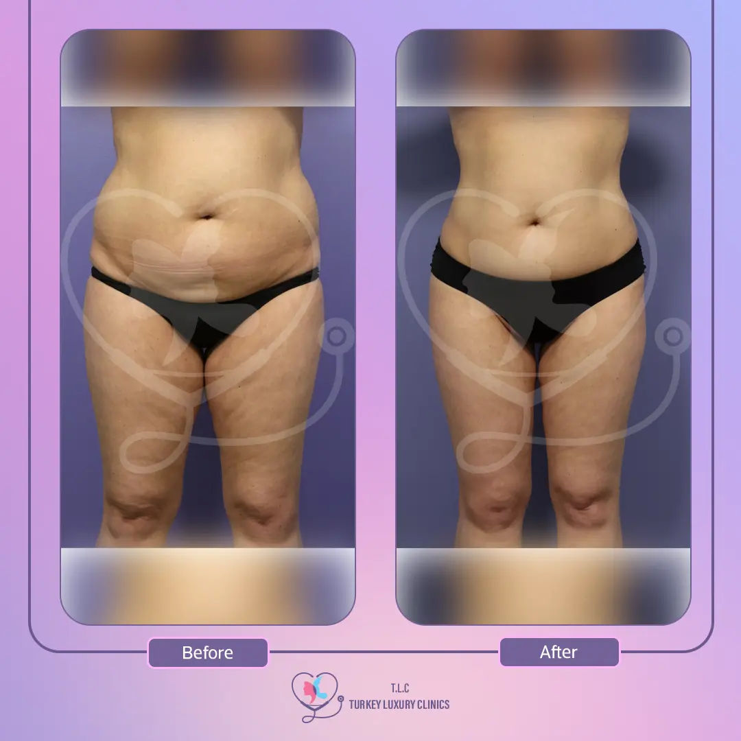 تكلفة شفط الدهون في تركيا