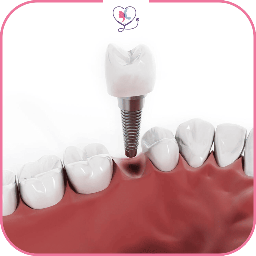 مخاطر زراعة الأسنان