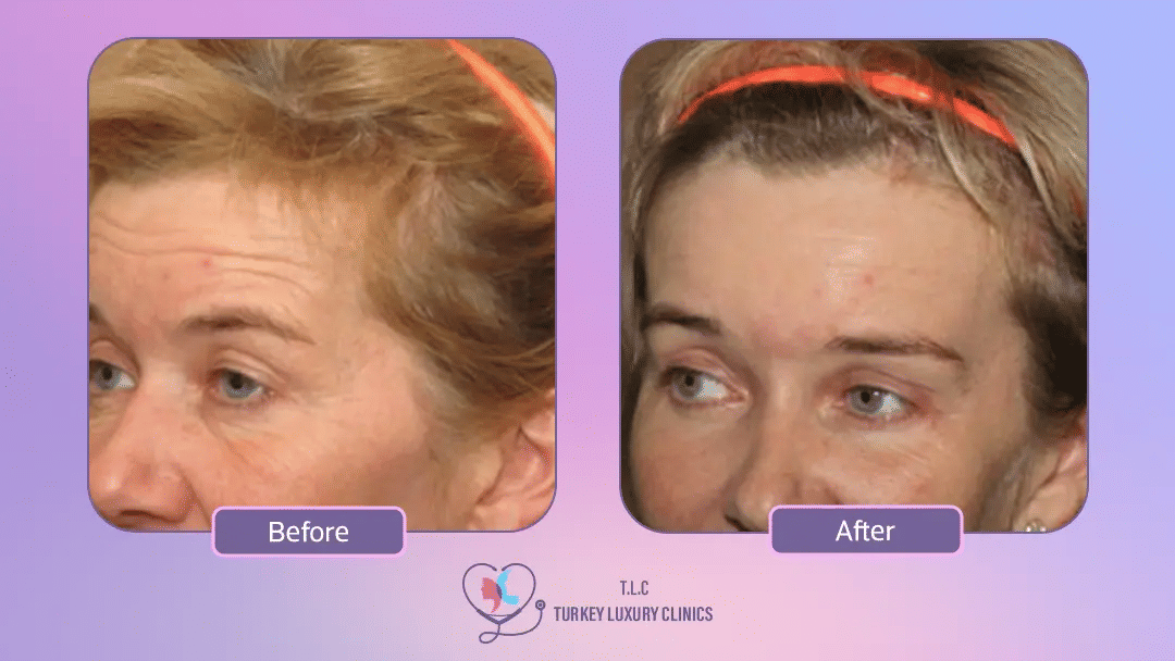 تكلفة عملية شد الجبهة في تركيا لاكشري كلينك