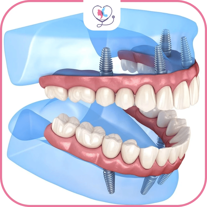 Exploring the Different Types of Dental Implants: Finding the Right Fit for You