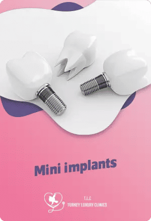 Mini Implants: A Smaller Solution for Specific Needs and Smile Enhancementfeatured image