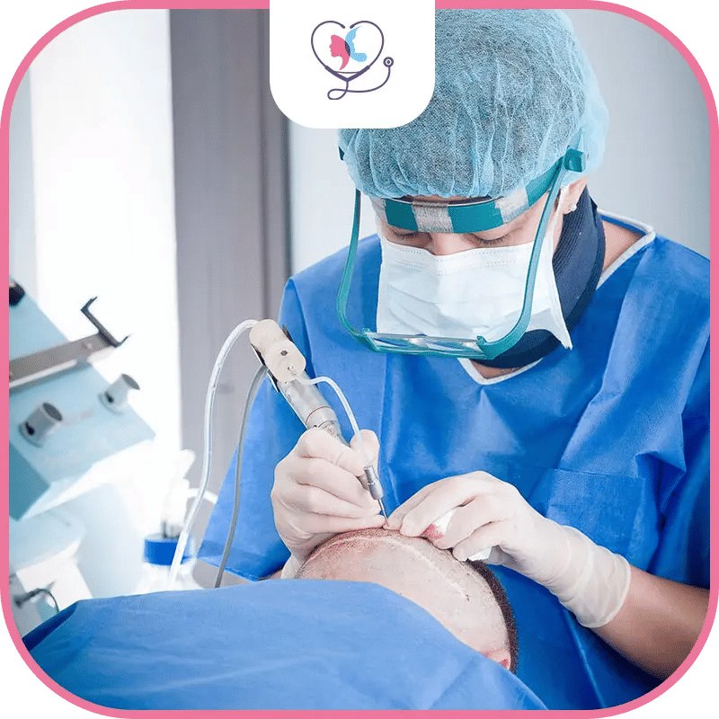 ما هي زراعة الشعر بالاقتطاف FUE؟