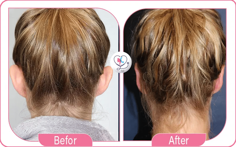 Otoplasty Recovery in Children vs Adults 2
